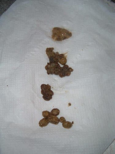 Stool Abnormalities: Mucus, Blood, and Color (With Pictures) - HubPages