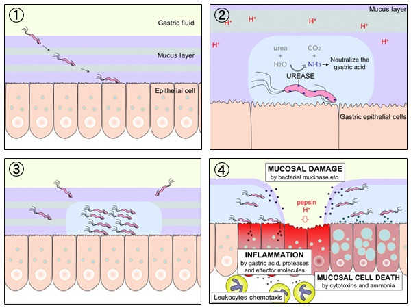The process of gastric ulceration by H. pylori