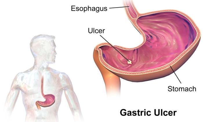 A gastric ulcer in the stomach