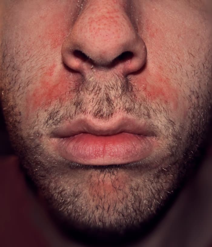 Itchy, flaking, greasy, red, and inflamed skin commonly occurs on the face, at the corners of the nostrils.