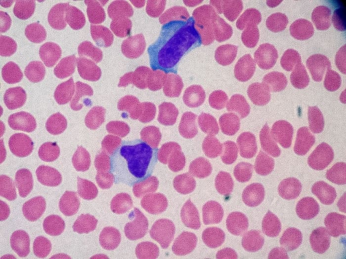 A stained blood smear from someone with infectious mononucleosis; the blue cells are reactive lymphocytes while the pink cells are red blood cells