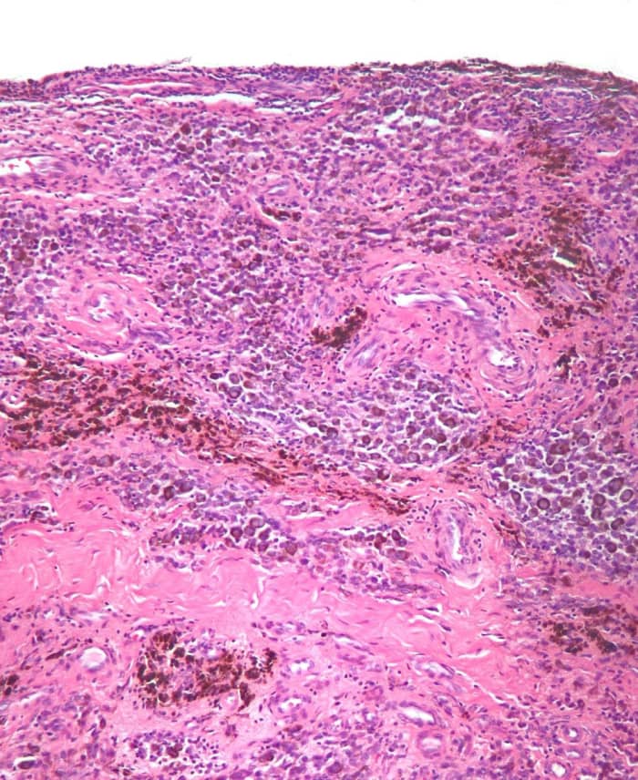 This is a magnifield and stained piece of synovium from a PVNS patient. The brown areas contain macrophages (a type of white blood cell) filled with hemosiderin.