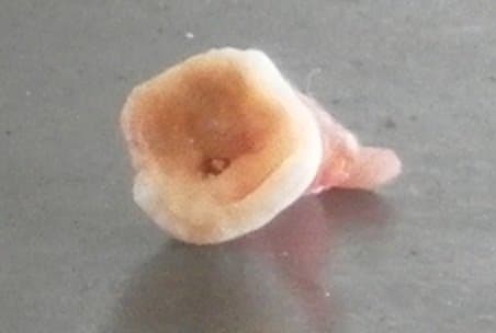 An easy lower jaw wisdom tooth to extract. This came out in 2 pieces. Note the crown which had partially crumbled prior to being removed.