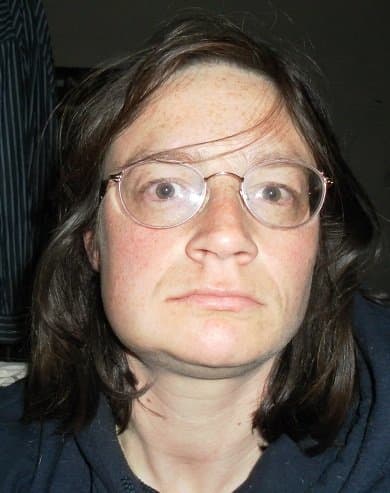 Be prepared to get some swelling. On the left side of the picture you can see that the right side of my face (which had the difficult tooth) is swollen