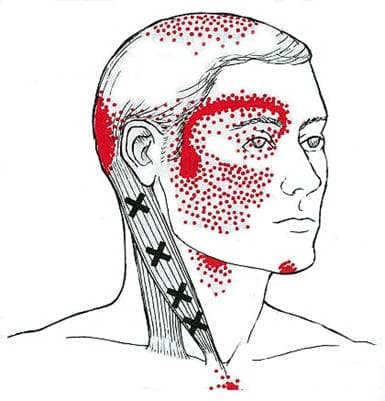 The Xs mark potential trigger points on the sternocleidomastoid muscle that is often the culprit of headaches.