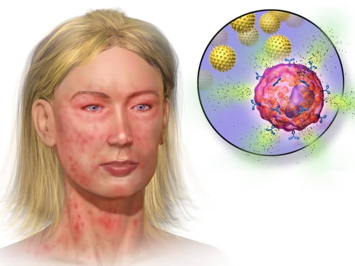 Anaphylaxis is a body-wide allergic response and is far more serious than hay fever. It also involves mast cell degranulation and histamine release, however.