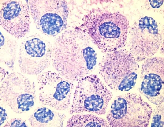 Mast cells coloured by a biological stain to show the nucleus (blue) and granules (pink and speckled areas)