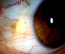 What Is Surfer's Eye? Pterygium and Pinguecula Explained - HubPages