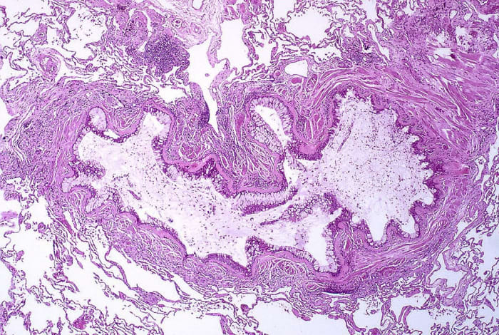 Untreated asthma can cause changes in the airways. In this picture, the lumen (cavity) inside a bronchiole has become obstructed. The bronchioles are important airways.