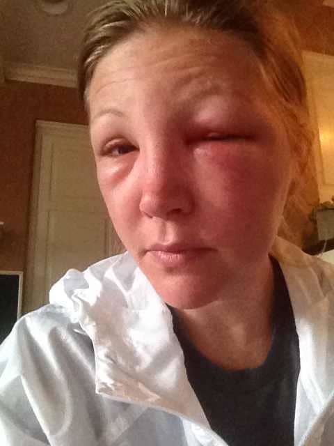 One day after the bee sting to the eye. I began prescription medication 24 hours after the initial sting.