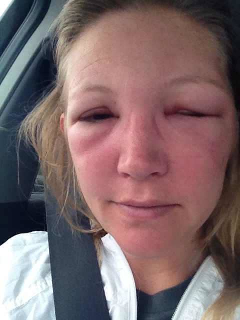 My Experience Of A Bee Sting Near My Eye With Photo