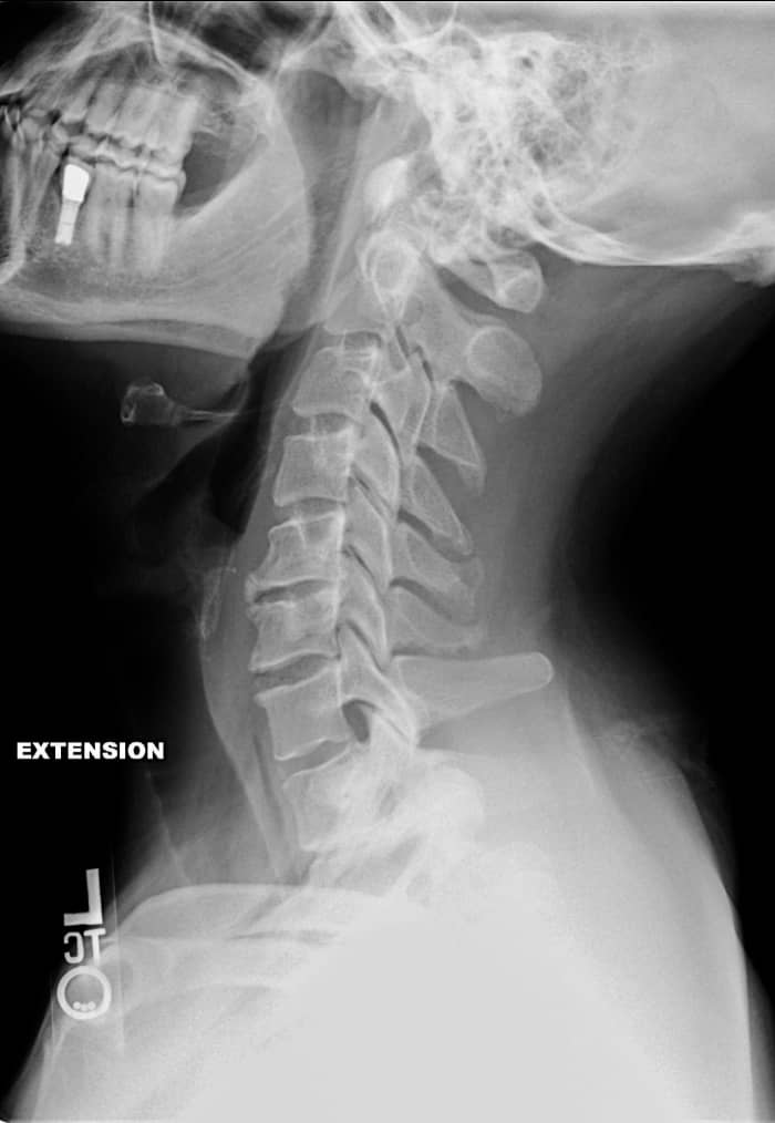 This patient has a bone spur in the neck. If you count the vertebrae from the top, you should be able to see the spur on the front edge of vertebra number five.