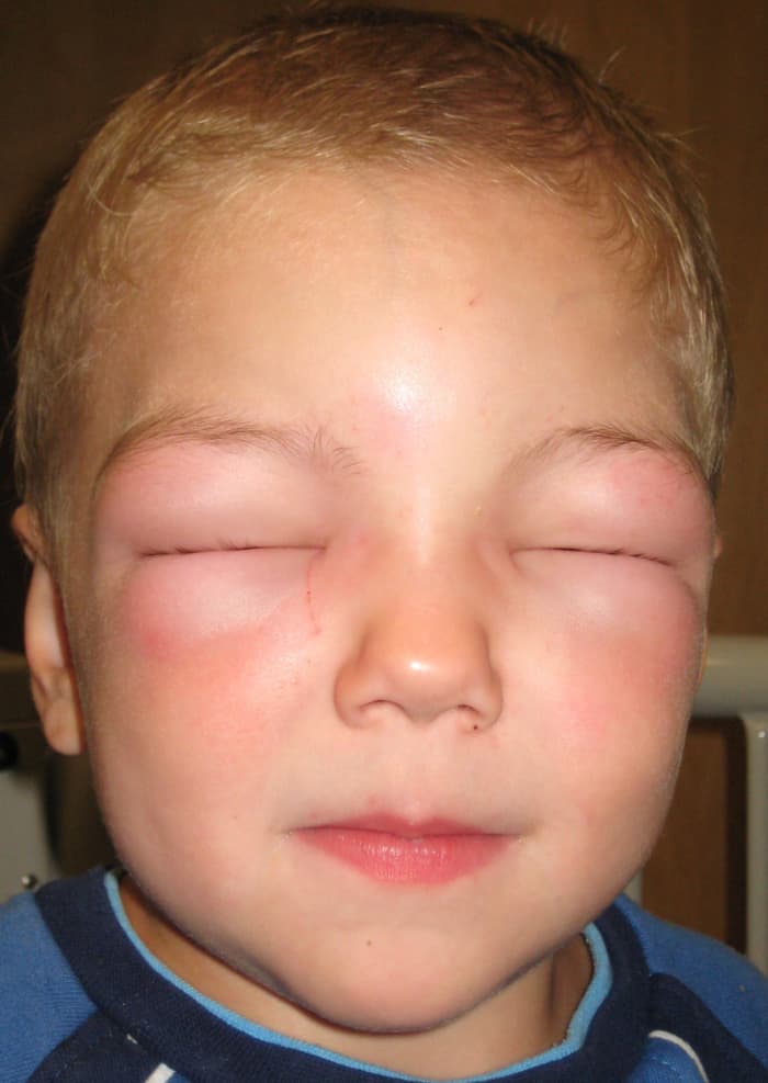 Eye Swelling