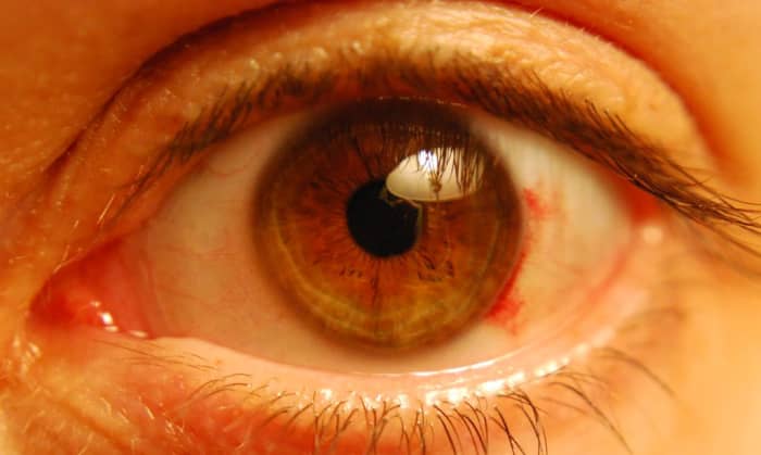 Subconjunctival Hemorrhage (Broken Blood Vessels in the Eye) - HubPages