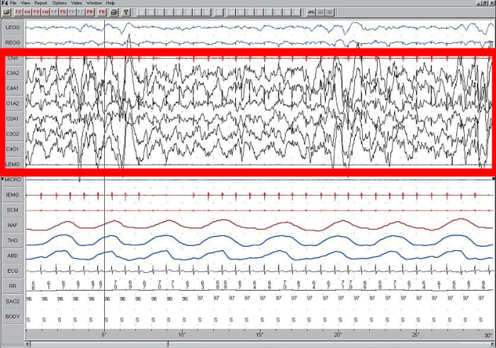 Slow wave sleep, as seen on this EEG, is indicative of a deep sleep. The sleeping person will be very difficult to rouse.