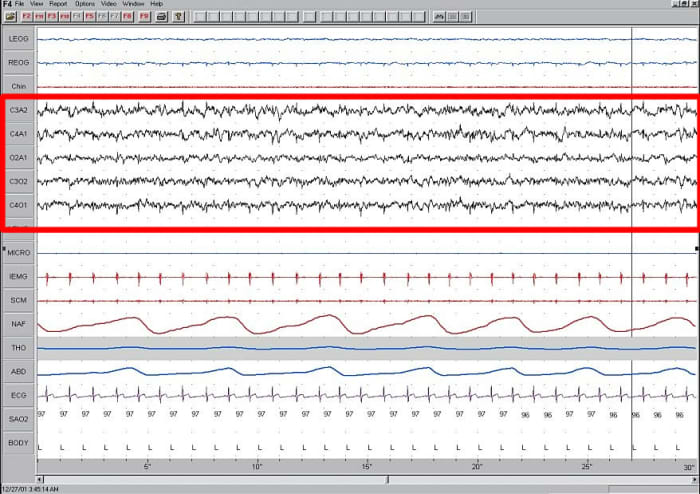 Stage 1 sleep EEG. Stage 1 sleep is marked by alpha waves, which indicate a very light phase of sleep.