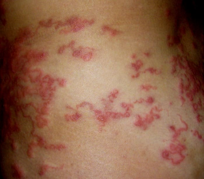 Heavy attack of larva migrans cutanea, hookworms under the skin.