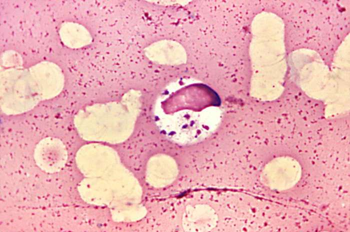 A stained specimen showing Leishmania inside a bone marrow cell