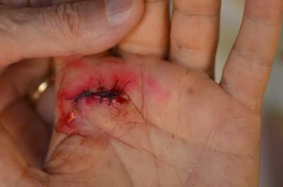 Ouch! Someone get this guy a BAND-AID®. A person with a Blood-Injection-Injury phobia may look at a wound like this and respond with panic, trembling, and even fainting.