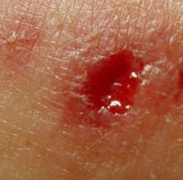 Identification and Treatment of a Wolf Spider Bite - YouMeMindBody