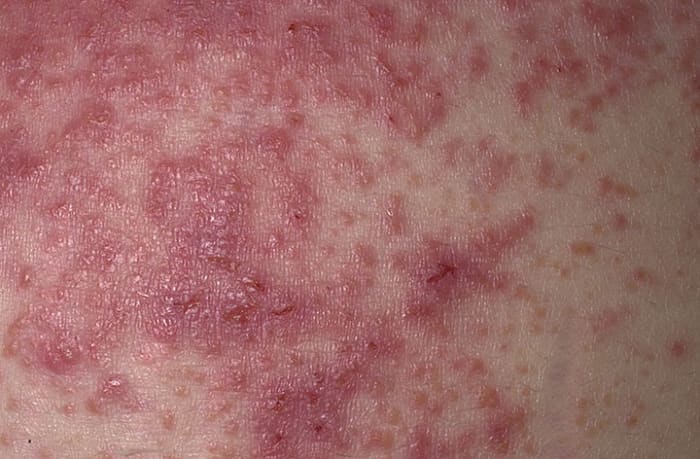 This is what eczema might look like. Look for redness, minute papules or vesicles (that look like pimples) which might be weeping, oozing, or crusting.