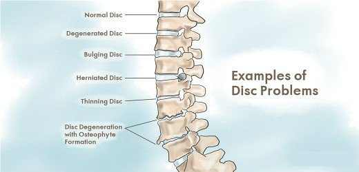 Disc problems that may cause back pain.