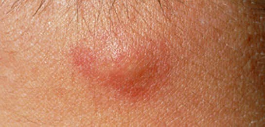 Causes and Treatments of Lumps: Neck, Armpit, Wrist, & More - YouMeMindBody