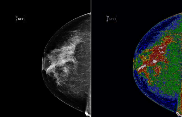 Microcalcifications present as tiny, solid white dots on a mammagram as shown on the top left black and white photo.