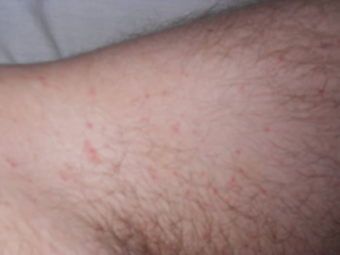 Scabies often affect the groin, which can be intensely itchy and socially awkward to scratch.