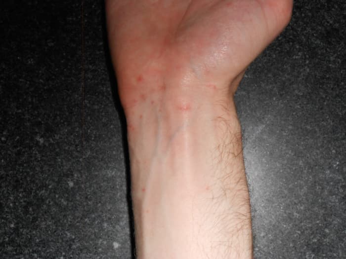 Scabies typically follow a highly predicable pattern: the writs, between the fingers, between the toes, and the groin are extremely common targets for infestation.