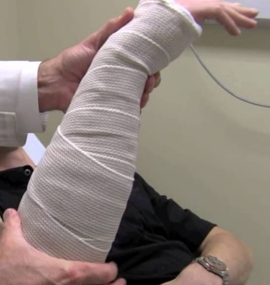 This is the kind of temporary splint I ended up wearing for 2+ weeks! Mine almost completely covered my fingers. It was extremely heavy, restrictive and uncomfortable.