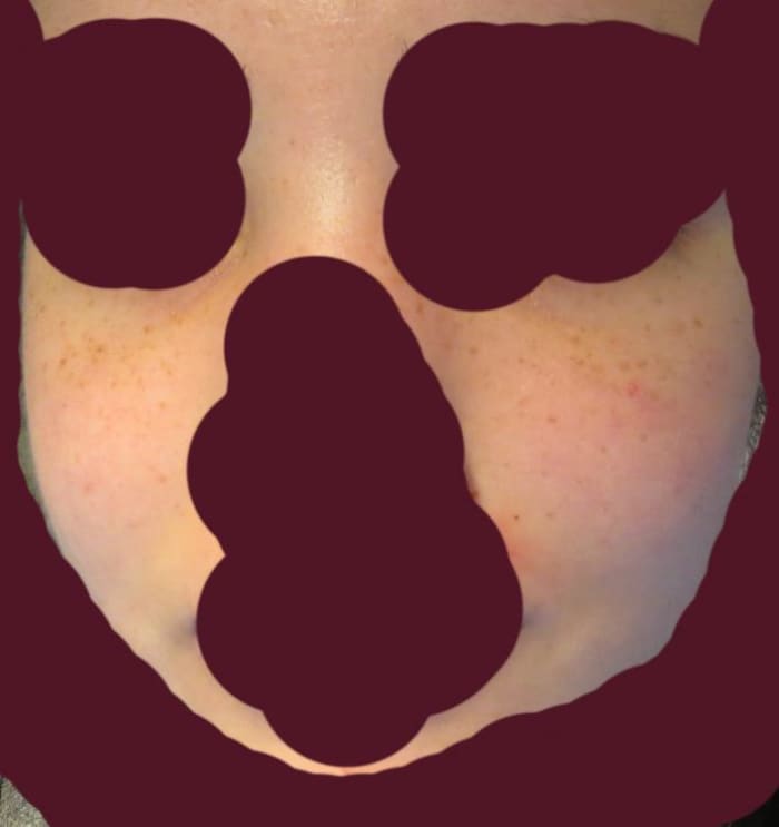 Skin after Accutane: acne-free, temporary scarring fading. Now, 4 years later, my skin is absolutely perfect and I can hardly remember having acne/identifying with that health problem.