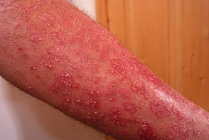 Infantigo (Impetigo): Symptoms, Causes, Types, Diagnosis, Risk Factors, Treatment, Remedies and Prevention