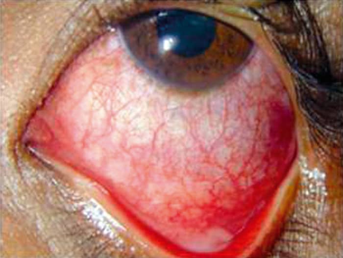 Pink eye can be caused by a variety of factors: viruses, bacteria, allergens, or foreign objects. The color of the discharge (clear, yellow, or green) can help your doctor discern the likely source of your ailment.