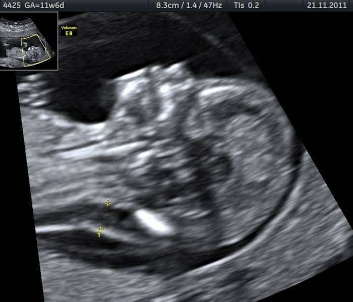 Edema in the nuchal fold and an absence of a nasal bone are observed in this ultrasound at 11 weeks of gestation. This baby has Trisomy 21 (Down Syndrome), as confirmed by Chorionic Villus Sampling testing.