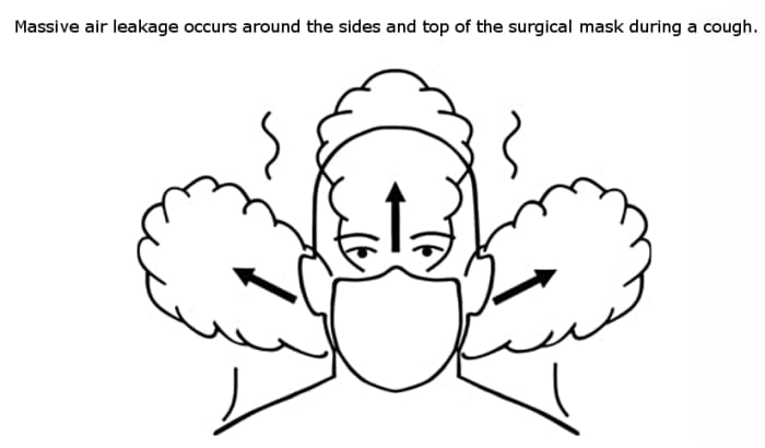 Figure 5. Front view of air leakage around a surgical mask, adapted from Figure 6, Section e in Tang et. al. (2009).