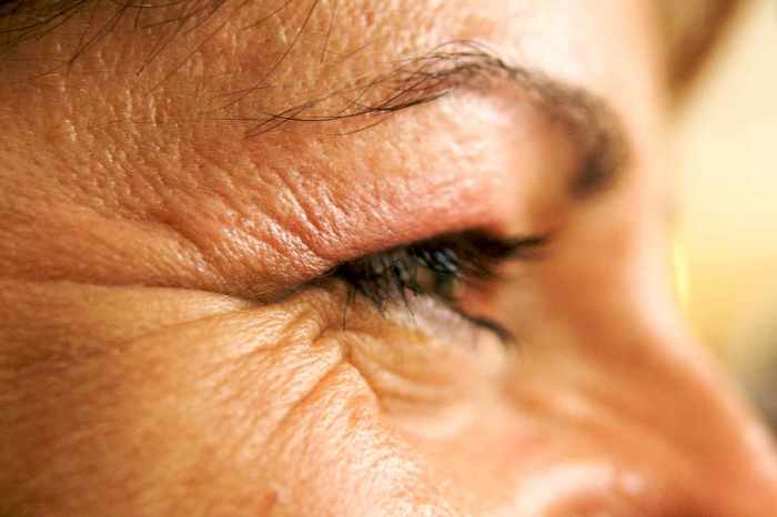 Eye Wrinkles that have obviously not yet been treated by glycerin.