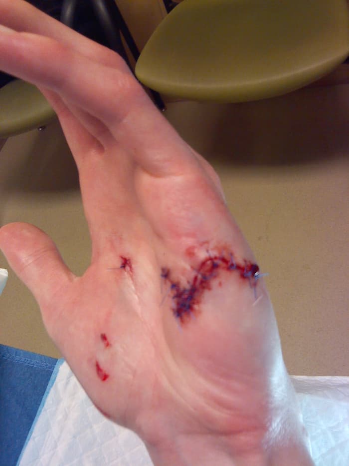 My hand, post-suturing. This is the worst of it—the other side had four more individual stitches to account for individual punctures.