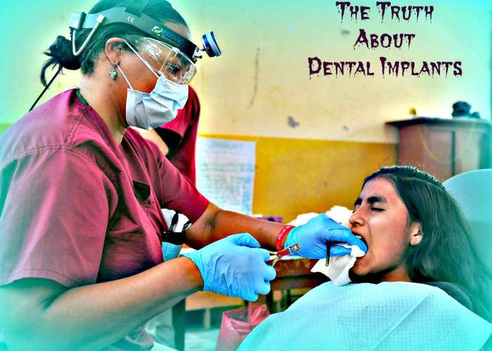 Before you get an implant, make sure you know all of the facts.