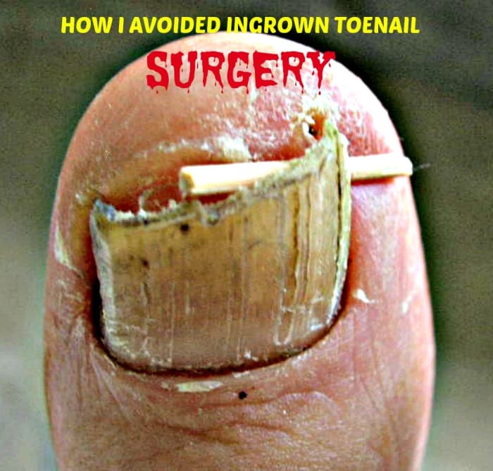 Some ingrown toenail home remedies work. Others do not. It's best to see a Podiatrist early so that you can avoid surgery.