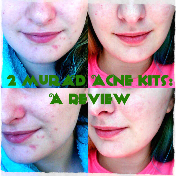 Before and after Murad acne kits.