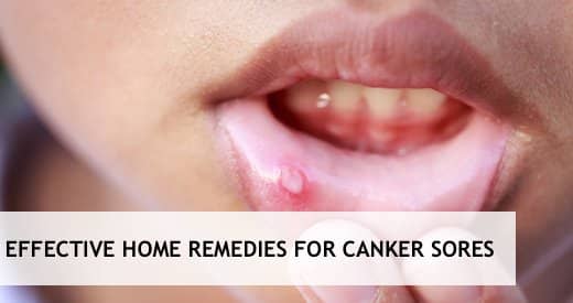 Canker sores are small lesions that commonly occur on the soft tissues in the mouth or at the base of the gums. The real cause of these ulcers is poorly understood.