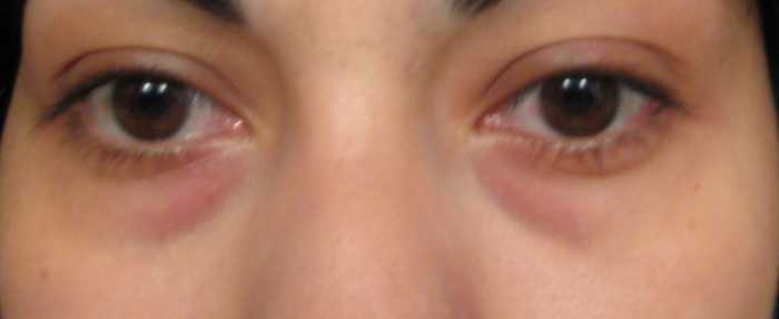 Do you have dark circles under your eyes?