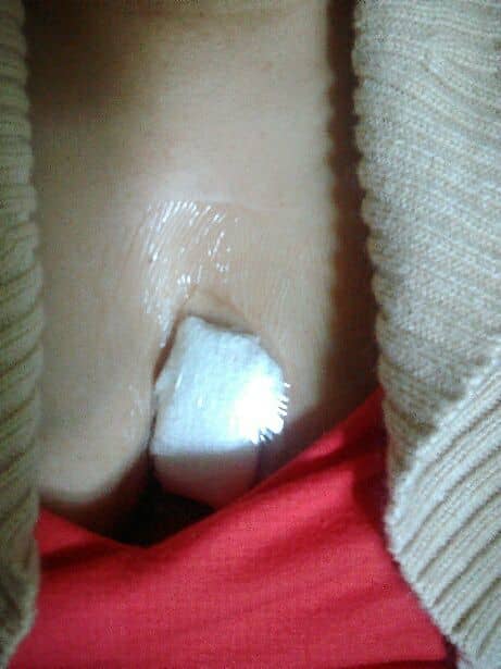 After the surgery, a small bandage was placed over the surgical site. I was unable to shower the first day and unable to get the area wet for at least four days.
