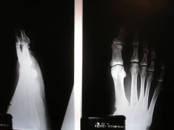 3-workouts-you-can-do-with-a-foot-injury