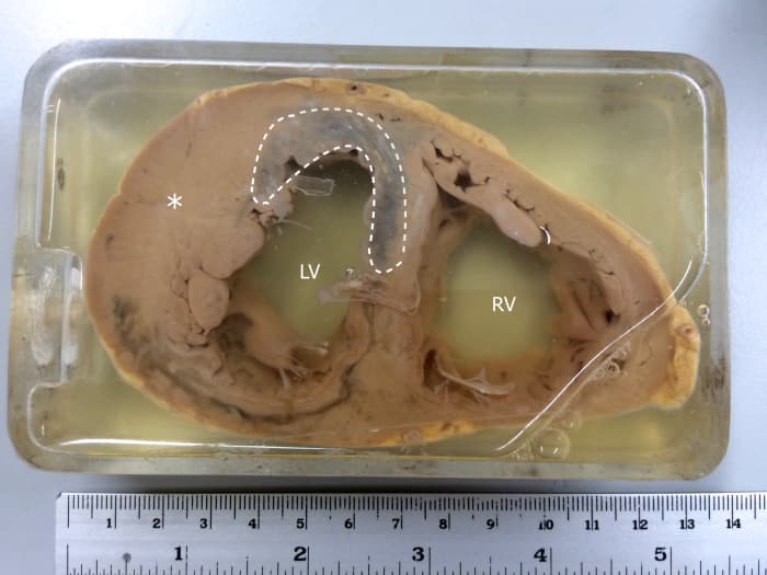 Specimen showing myocardial infarction in the left ventricle and the interventricular septum. The asterisk(*) also indicates left ventricular hypertrophy.
