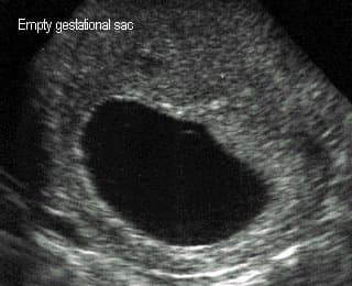 This is not my ultrasound picture, but this is what the doctor will see if you have a blighted ovum. There is an empty gestational sac with no yolk sac or fetus visible.