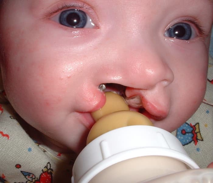 One of the first difficulties we encounter is how to feed. With a cleft palate, a baby can't suck well. With a cleft lip it's hard to grip the nipple. This bottle is a special adaptation developed long after I was born.