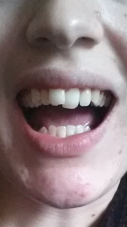 To give you some idea of the treatment I went through, this is a photo of my teeth before I had any treatment. I had over-crowding, which had pushed my front teeth to overlap, and I had very crooked bottom teeth. I also had a slight over-bite.