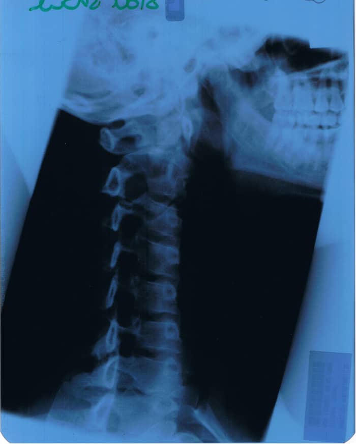 Here is the photo of my neck showing how straight it was from tight muscles. Normally the neck is curved.
